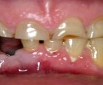 Damaged Teeth - candidate for cosmetic veneers and crowns