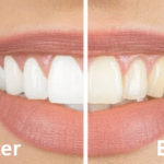 Veneers - before and after