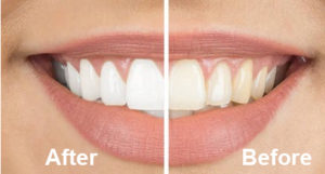 Porcelain Veneers - before and after