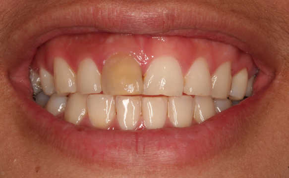 front tooth root canal