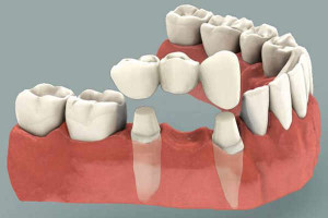 Dental Bridges Raleigh NC - Gover and Gover Dentistry