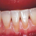 Receding Gums - Causes, Risks and Treatment