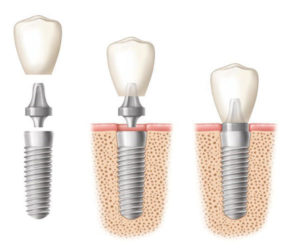 Implant Dentist Raleigh NC